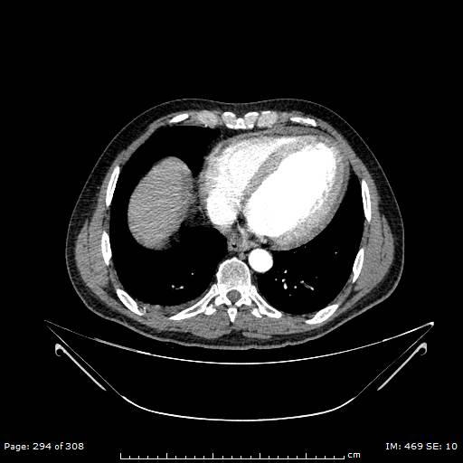 Ascending aortic aneurysm (Radiopaedia 50086-55404 A 75).jpg