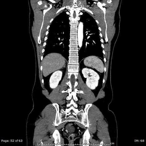 Ascending aortic aneurysm (Radiopaedia 50086-55404 B 52).jpg