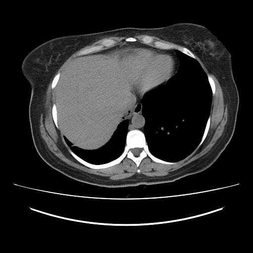 Ascending retrocecal appendicitis with liver abscesses (Radiopaedia 60066-67615 Axial non-contrast 8).jpg
