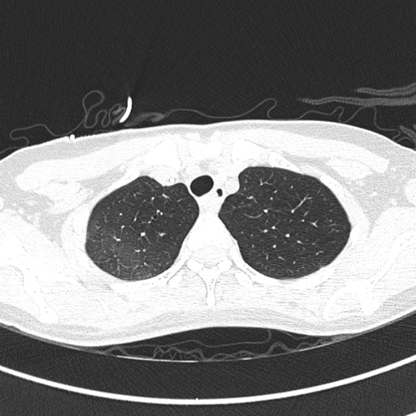 File:Aspergilloma (Radiopaedia 26223-26347 Axial lung window 14).jpg