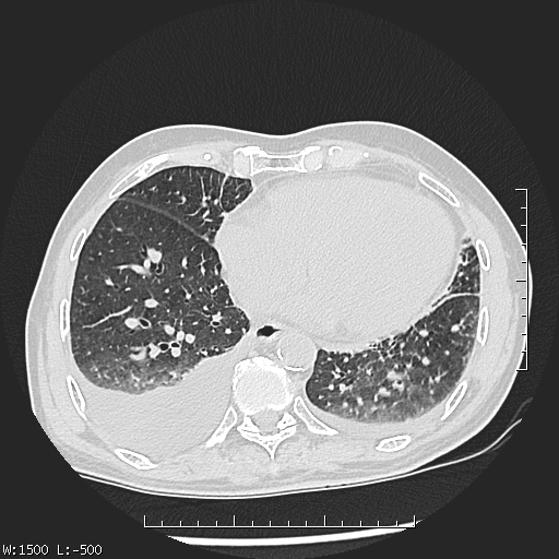 Aspergilloma (Radiopaedia 75184-86270 Axial lung window 38).jpg