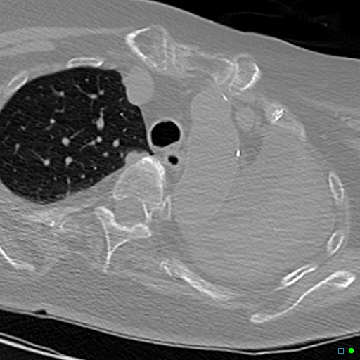 File:Aspirated food bolus obstruction of left main bronchus (Radiopaedia 29432-29904 Axial non-contrast 5).jpg