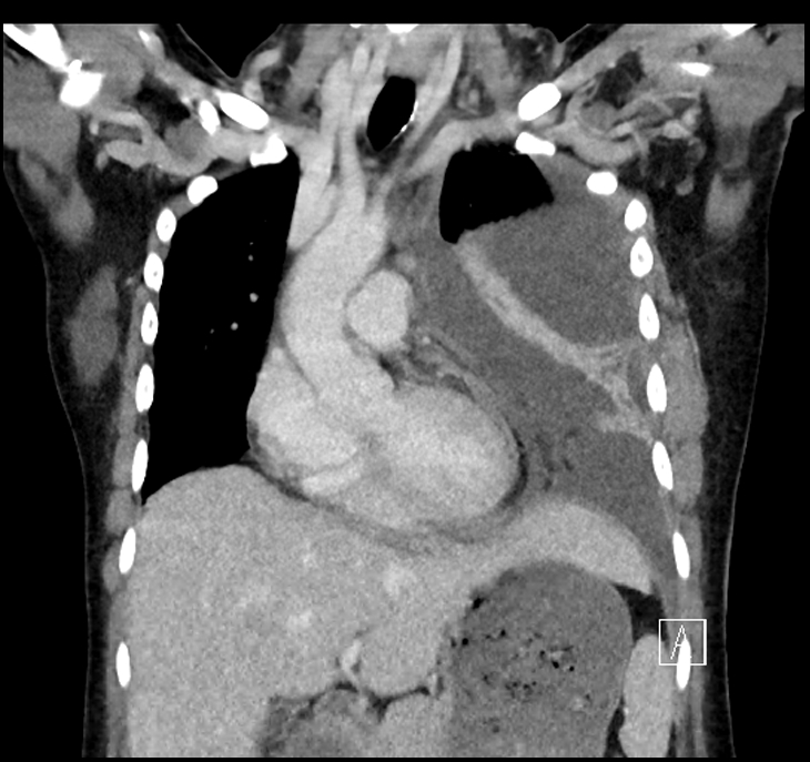 Aspiration pneumonia complicated by empyema (Radiopaedia 73024-83767 A 18).jpg