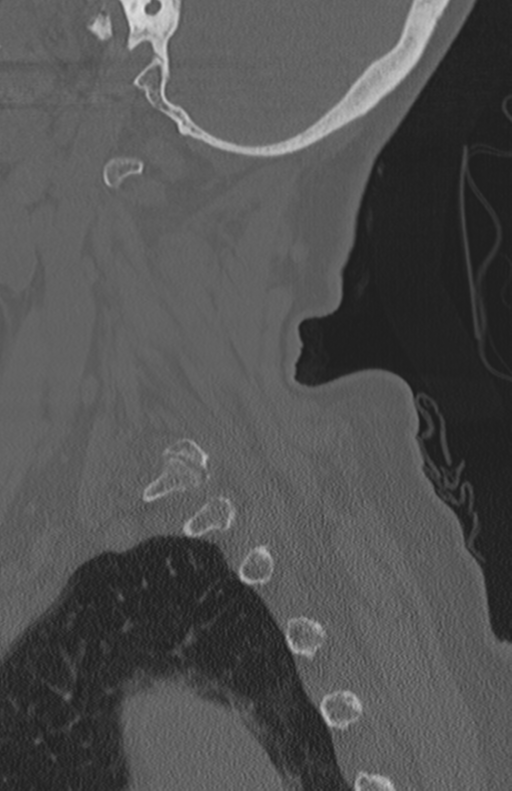 Atlanto-axial subluxation (Radiopaedia 36610-38176 Sagittal bone window 20).png