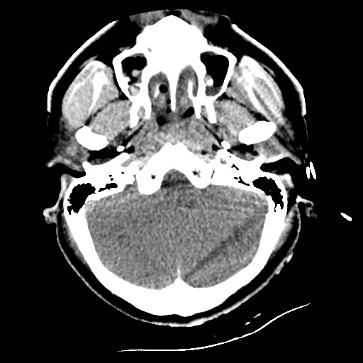 File:Atlanto-occipital dislocation (Radiopaedia 44648-48412 Axial non-contrast 12).jpg
