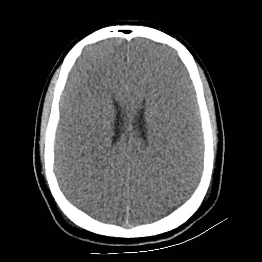 File:Atlanto-occipital dislocation (Radiopaedia 44648-48412 Axial non-contrast 36).jpg
