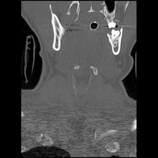 Atlanto-occipital dissociation injury (Radiopaedia 29274-29698 Coronal bone window 51).png