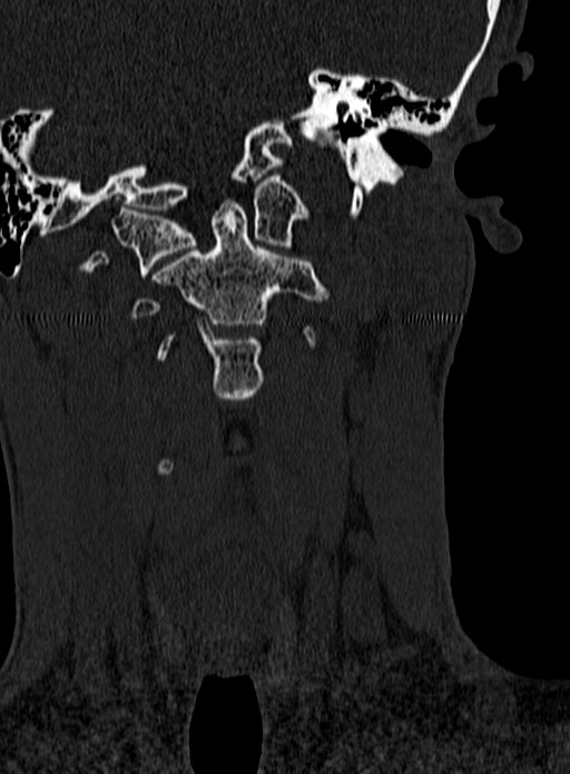 Atlantoaxial subluxation (Radiopaedia 44681-48450 Coronal bone window 23).jpg