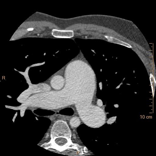 Atrial septal defect (upper sinus venosus type) with partial anomalous pulmonary venous return into superior vena cava (Radiopaedia 73228-83961 A 55).jpg