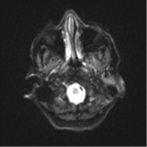 Atypical meningioma (WHO Grade II) (Radiopaedia 54742-60979 Axial DWI 3).png