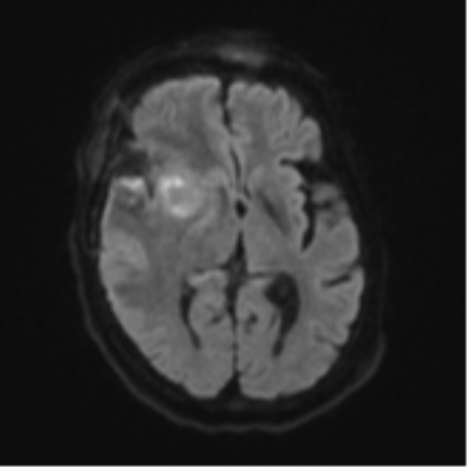 File:Atypical meningioma (WHO Grade II) (Radiopaedia 54742-60981 Axial DWI 42).png