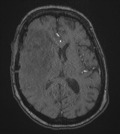 Atypical meningioma (WHO Grade II) (Radiopaedia 54742-60981 Axial MRA 55).png