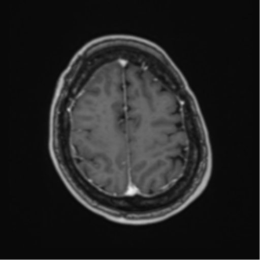 File:Atypical meningioma (WHO Grade II) (Radiopaedia 54742-60981 Axial T1 C+ 57).png