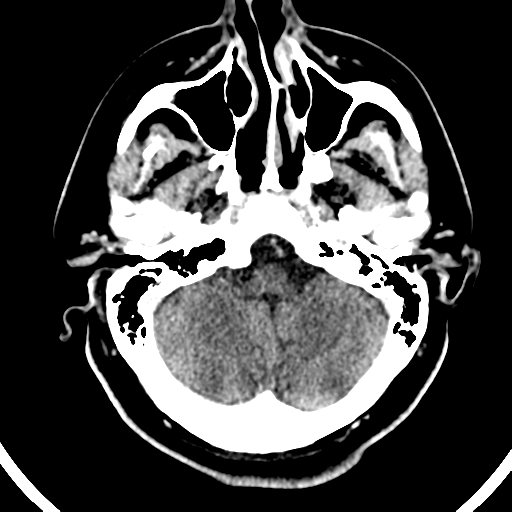 Atypical meningioma (WHO grade II) with brain invasion (Radiopaedia 57767-64728 Axial C+ 46).png