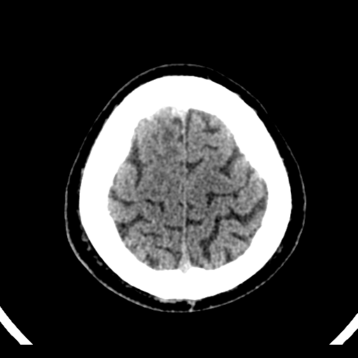 File:Atypical meningioma (WHO grade II) with brain invasion (Radiopaedia 57767-64728 Axial non-contrast 40).png