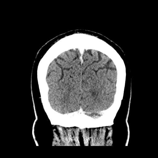 Atypical meningioma (WHO grade II) with brain invasion (Radiopaedia 57767-64728 Coronal C+ 55).png