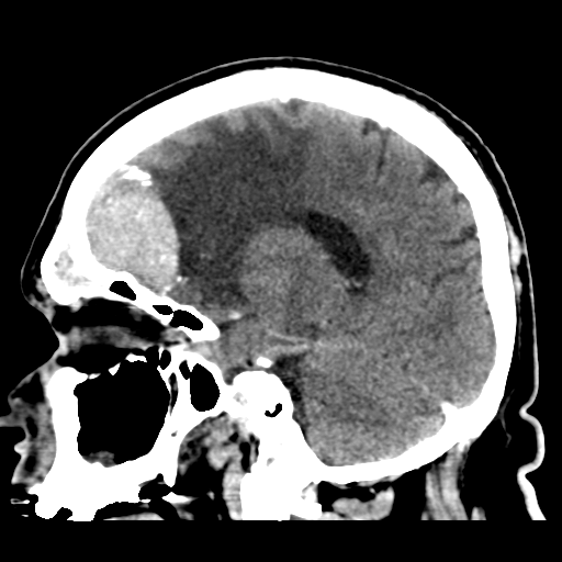 Atypical meningioma (WHO grade II) with brain invasion (Radiopaedia 57767-64728 Sagittal C+ 20).png