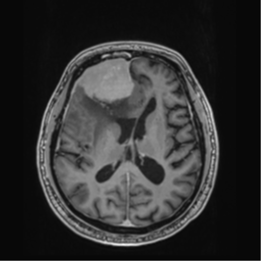 Atypical meningioma (WHO grade II) with brain invasion (Radiopaedia 57767-64729 Axial T1 C+ 27).png