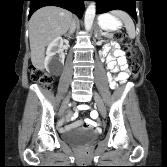 File:Atypical renal cyst (Radiopaedia 17536-17251 C 16).jpg