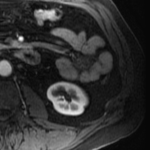 File:Atypical renal cyst on MRI (Radiopaedia 17349-17046 C 24).jpg