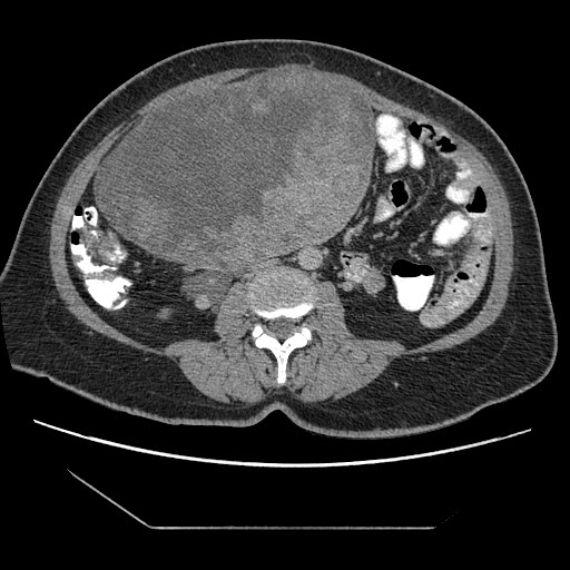 File:Atypical retroperitoneal lymphocoeles with large leiomyoma of uterus (Radiopaedia 32084-33024 A 21).jpg