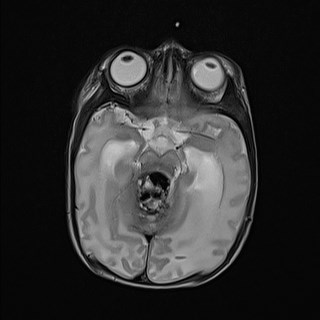 File:Atypical teratoid rhabdoid tumor (prenatal US and neonatal MRI) (Radiopaedia 59091-66388 Axial T2 13).jpg
