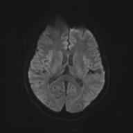 Autoimmune limbic encephalitis (Radiopaedia 30363-31005 Axial B0 and DWI 50).jpg