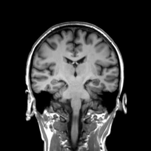Autoimmune limbic encephalitis (Radiopaedia 30363-31005 Coronal T1 27).jpg