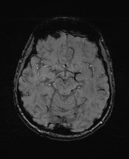 Autoimmune limbic encephalitis (Radiopaedia 30363-31005 SWI 31).jpg