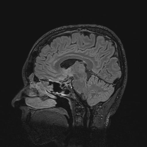 Autoimmune limbic encephalitis (Radiopaedia 30363-31005 Sagittal FLAIR 74).jpg