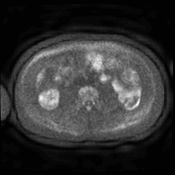 Autoimmune pancreatitis (Radiopaedia 69751-79729 DWI 70).jpg