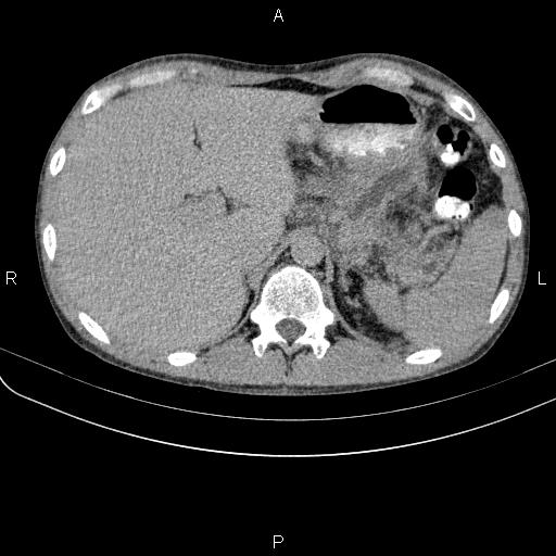 Autoimmune pancreatitis (Radiopaedia 84925-100431 Axial C+ delayed 13).jpg