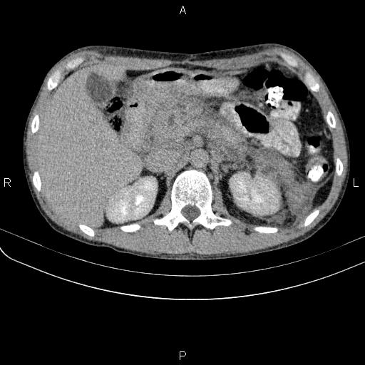 Autoimmune pancreatitis (Radiopaedia 84925-100431 Axial C+ delayed 22).jpg