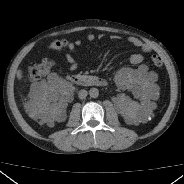 File:Autosomal dominant polycystic kidney disease (Radiopaedia 36539-38101 Axial non-contrast 41).jpg