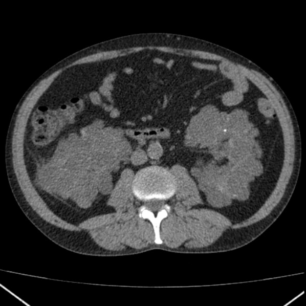 File:Autosomal dominant polycystic kidney disease (Radiopaedia 36539-38101 Axial non-contrast 44).jpg