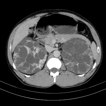 Autosomal dominant polycystic kidney disease (Radiopaedia 66349-75582 B 32).jpg