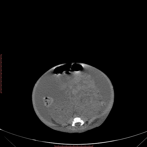 Autosomal recessive polycystic kidney disease associated with Caroli disease (Radiopaedia 61932-69984 B 254).jpg