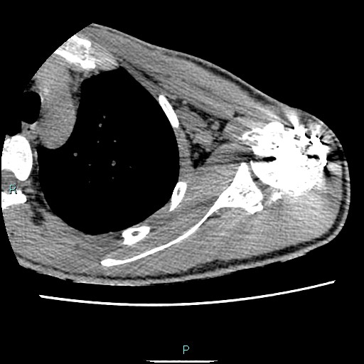 File:Avascular necrosis after fracture dislocations of the proximal humerus (Radiopaedia 88078-104653 D 43).jpg