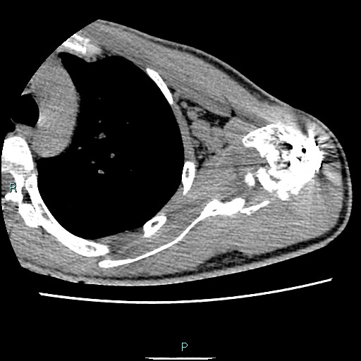 Avascular necrosis after fracture dislocations of the proximal humerus (Radiopaedia 88078-104653 D 48).jpg