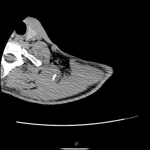File:Avascular necrosis after fracture dislocations of the proximal humerus (Radiopaedia 88078-104653 D 8).jpg
