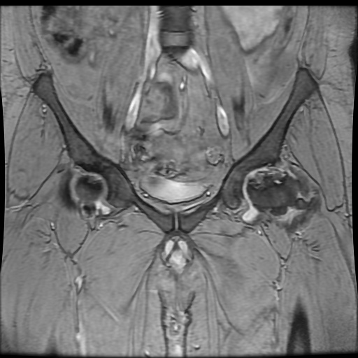 Avascular necrosis of the hip (Radiopaedia 61503-69465 F 30).jpg