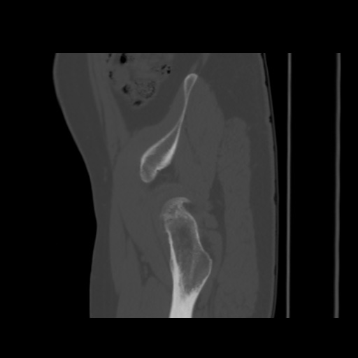 Avascular necrosis of the hip (Radiopaedia 61503-69467 B 10).jpg