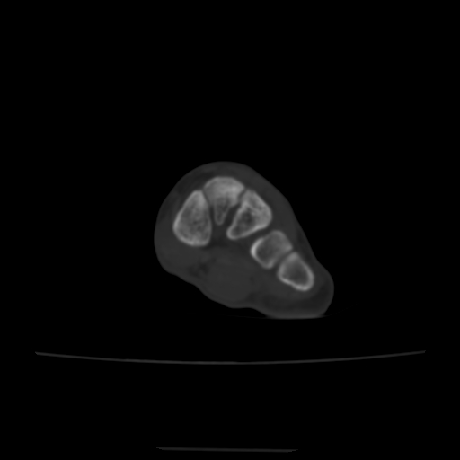 Avulsion fracture of the dorsal cuboid bone (Radiopaedia 51586-57377 Axial bone window 105).jpg