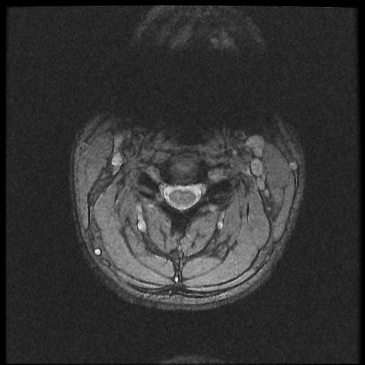File:Axis fracture - MRI (Radiopaedia 71925-82375 Axial T2 fat sat 9).jpg