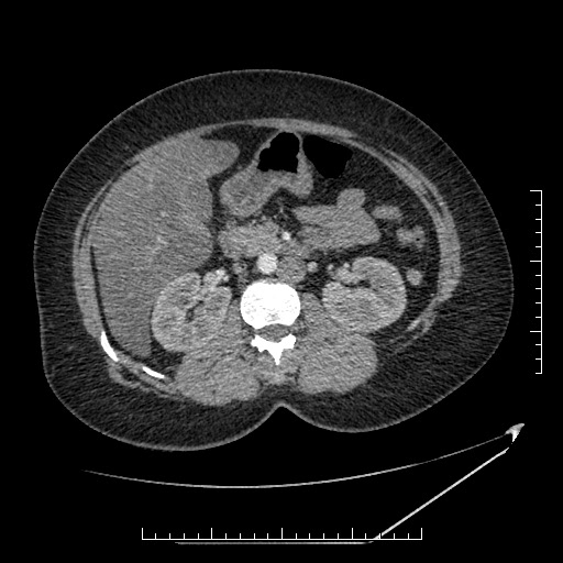 File:Azygos continuation of the IVC (Radiopaedia 40416-42965 A 34).jpg
