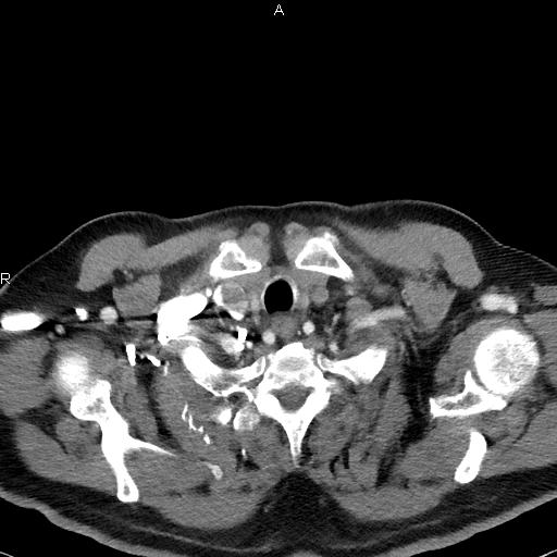 File:Azygos continuation of the inferior vena cava (Radiopaedia 18537-18404 C+ arterial phase 6).jpg