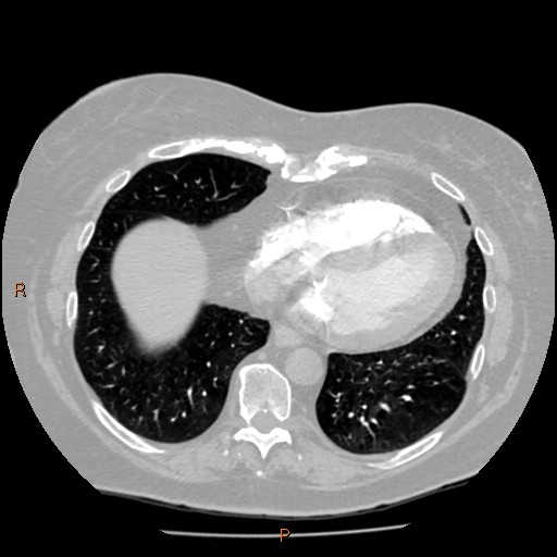 Azygos lobe (Radiopaedia 40161-42821 Axial lung window 53).jpg