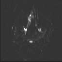 Balo concentric sclerosis (Radiopaedia 50458-55940 Axial DWI 46).jpg
