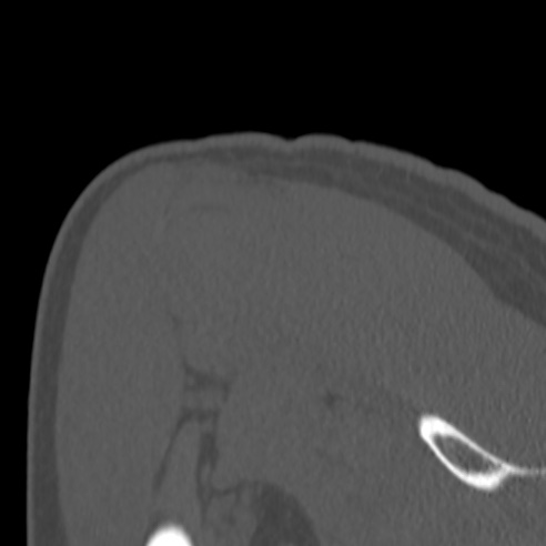 Bankart lesion (Radiopaedia 57256-64185 Coronal bone window 40).jpg