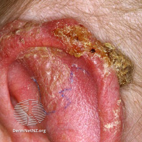 File:Basal cell carcinoma affecting the ear (DermNet NZ lesions-bcc-ear-0634).jpg